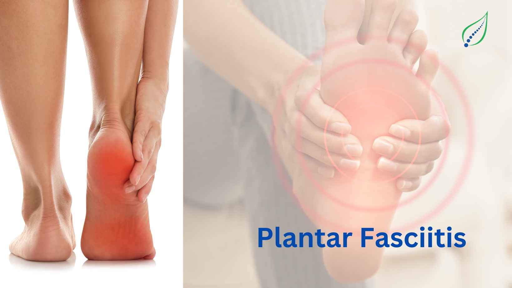 Plantar Fasciitis